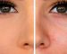 راهکارهایی برای بستن منافذ باز پوست صورت